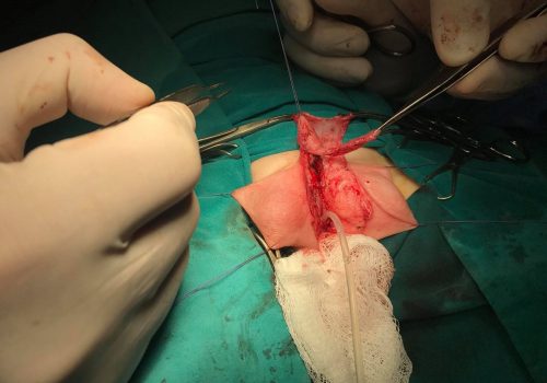 Araliq forma hipospadiya