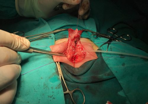 Araliq forma hipospadiya