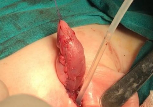 Araliq forma hipospadiya