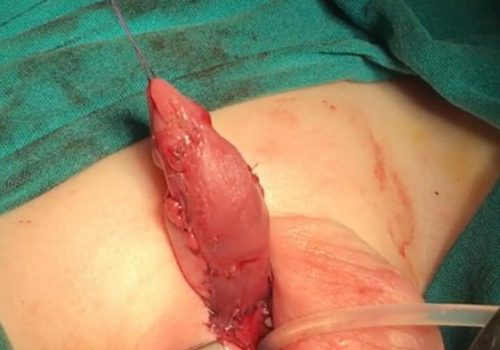 Araliq forma hipospadiya