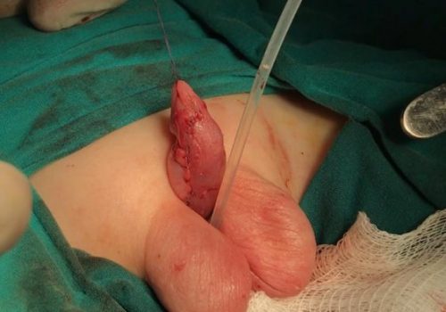 Araliq forma hipospadiya