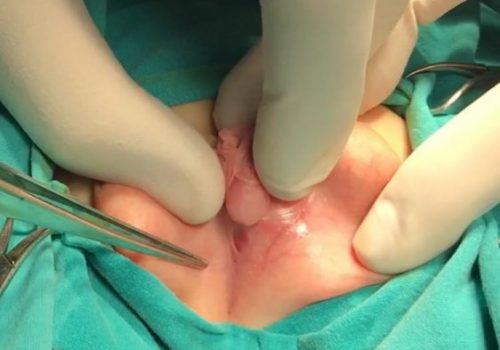 Araliq forma hipospadiya