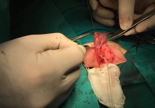 Araliq forma hipospadiya