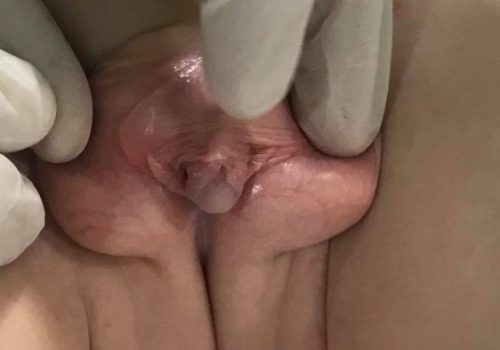 Araliq forma hipospadiya