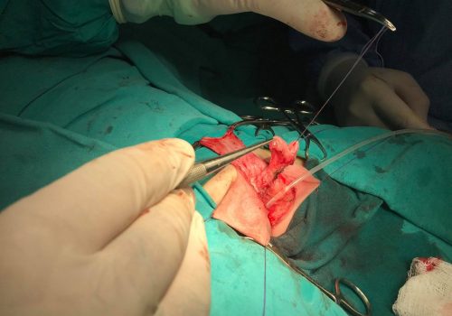 Araliq forma hipospadiya