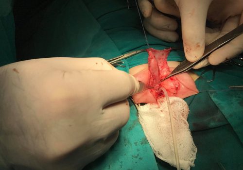 Araliq forma hipospadiya