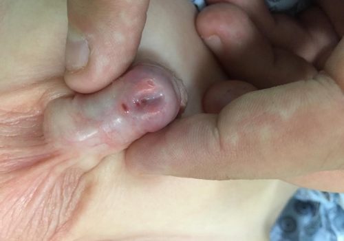 Distal forma hipospadiya