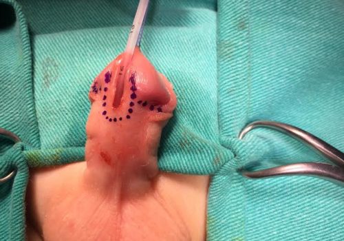 Distal forma hipospadiya