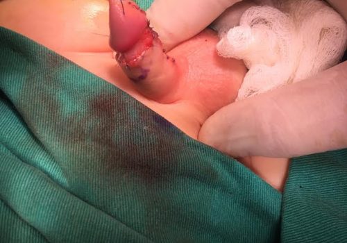 Distal forma hipospadiya