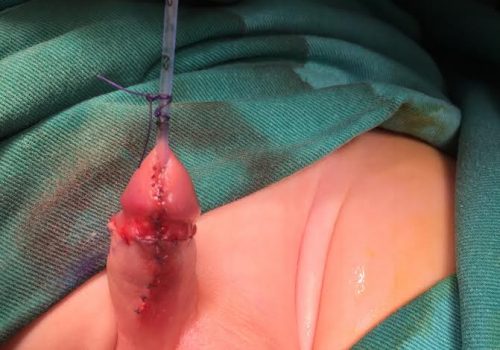 Distal forma hipospadiya