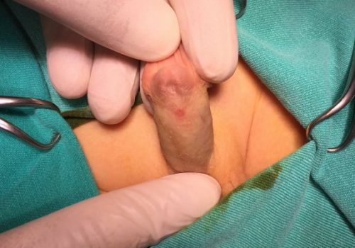 Distal forma hipospadiya