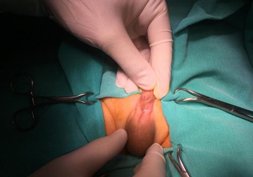 Penoskrotal forma hipospadiya