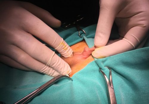 Penoskrotal forma hipospadiya