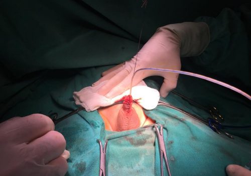 Penoskrotal forma hipospadiya