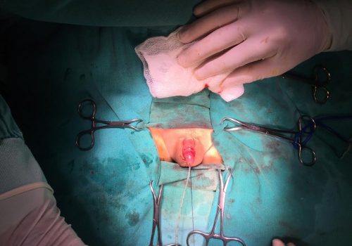 Penoskrotal forma hipospadiya