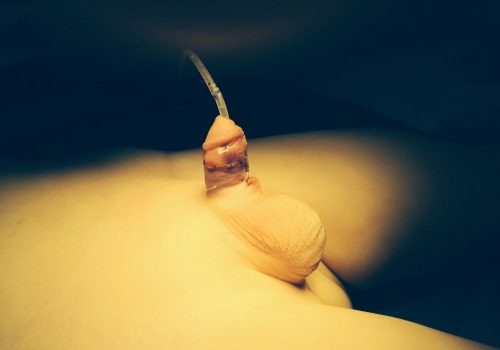 Subcoronal hipospadiya