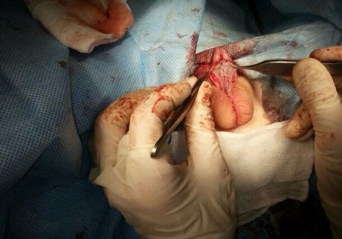 Xayaliq forma hipospadiya