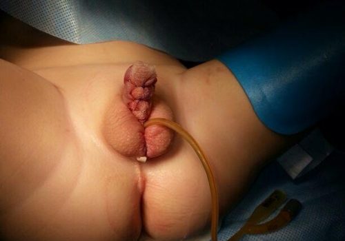 Xayaliq forma hipospadiya