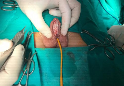 Xayalıq forma Hipospadiya 1